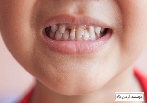 پوسیدگی دندان  یک اپیدمی مزمن پایدار در ایران